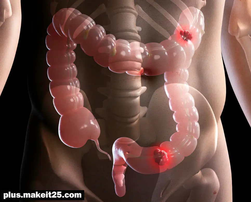 직장암 초기증상