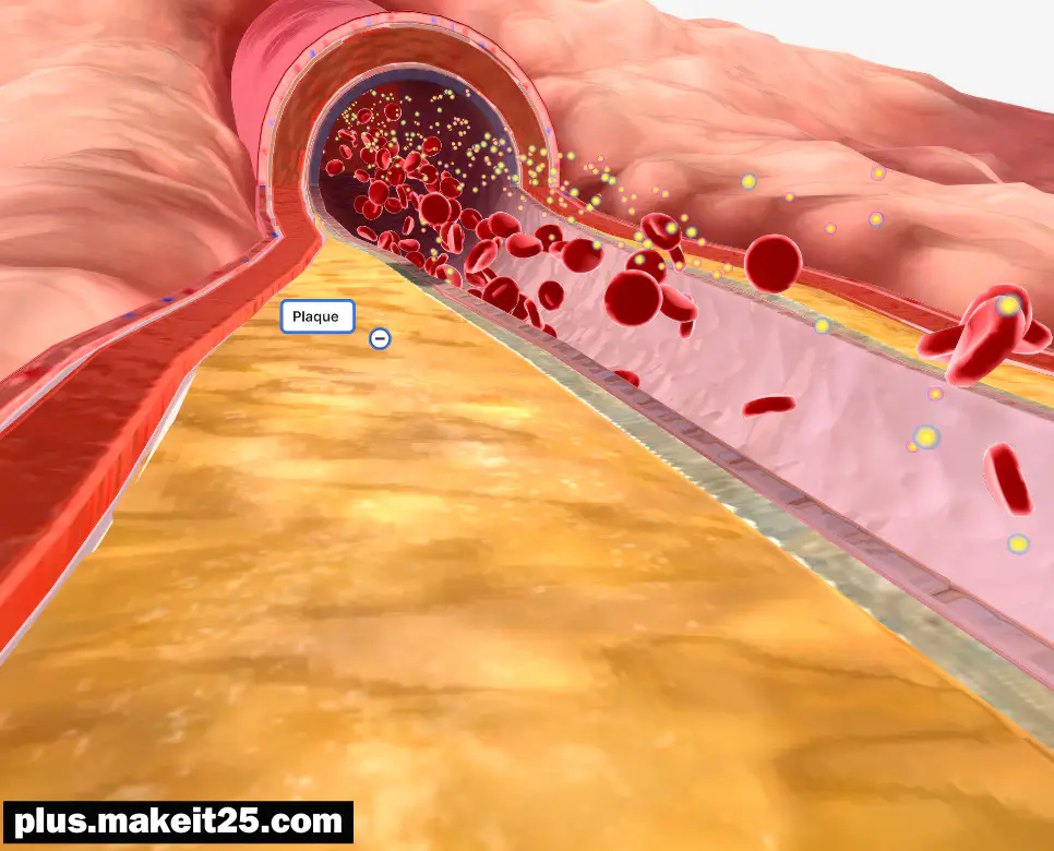 고지혈증 초기증상