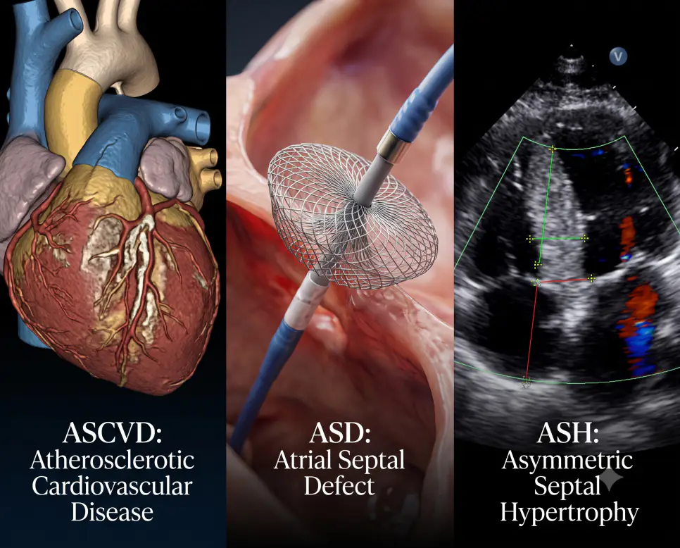 ASCVD 3D 혈관조영, ASD 니티놀 기구 거치, ASH 심근 초음파 현장을 현대적인 의학 포스터 레이아웃과 세련된 타이포그래피로 연출한 3분할 파노라마 인포그래픽